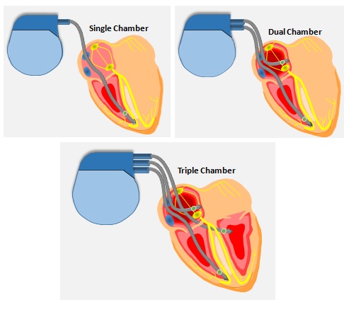 Types of pacemakers (depends on chamber)